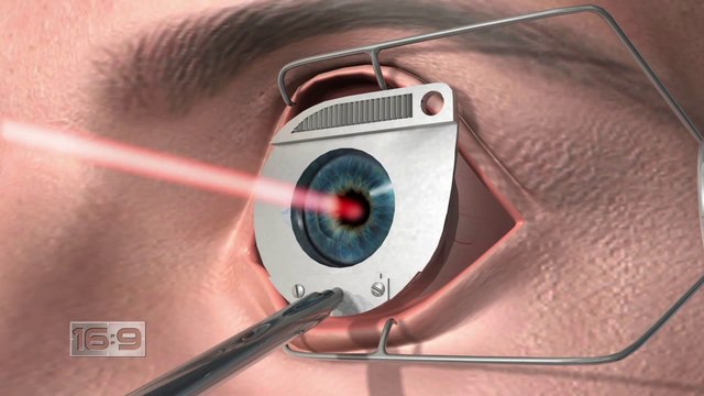 Laser eye surgery