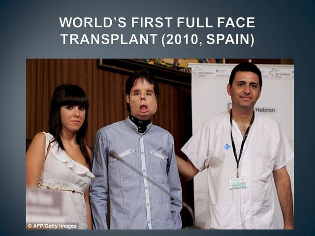 First full face transplant