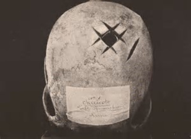 Ancient brain surgery