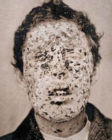 Smallpox is eradicated