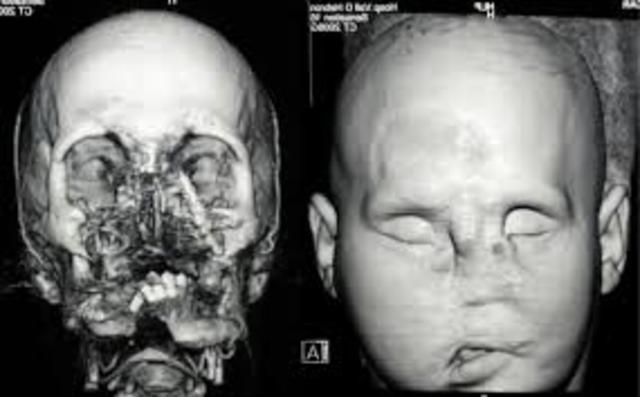 World's First Full Face Transplant