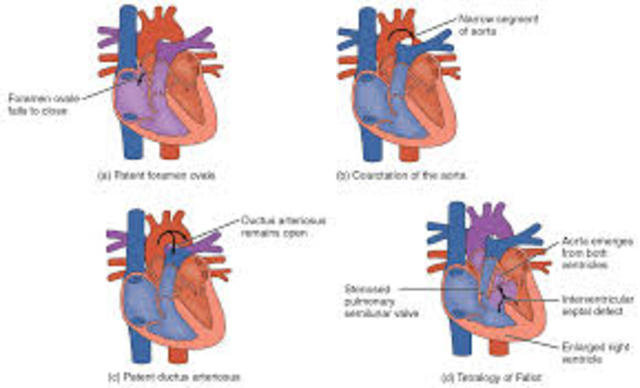 Congenital Heart defects