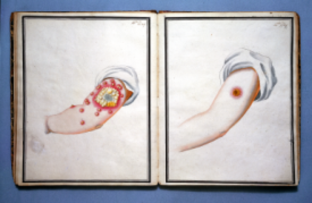 Smallpox inoculations