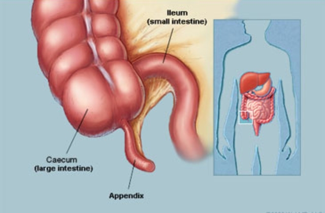 Appendicitis (Renaissance)