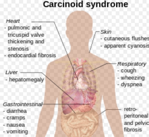 Carcinoid (Modern Era)