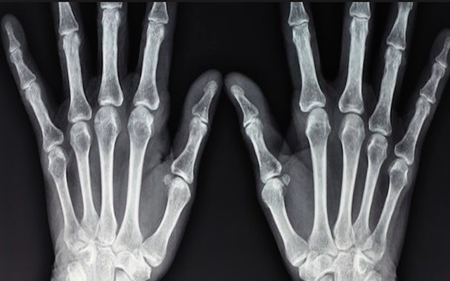 Wilhem Röntgen scopre i raggi X