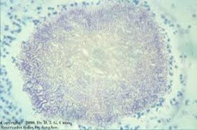 descripción de micetoma