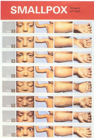 Smallpox