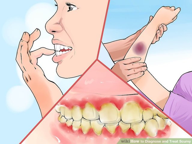 Prevention of Scurvy