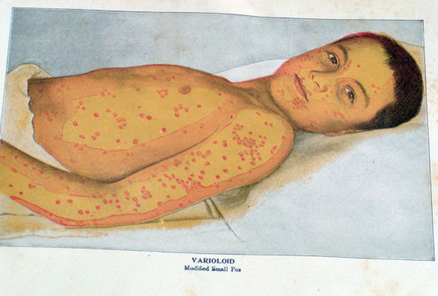Smallpox -1901