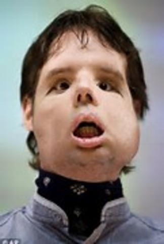 Face Transplants