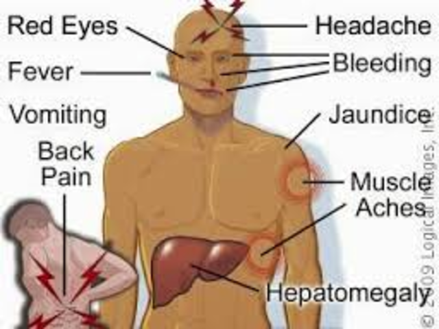 Yellow Fever outbreak in United States