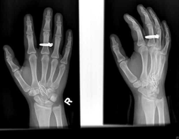 diamonds are seen on X-rays