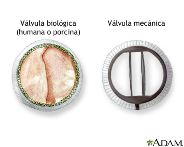 Válvulas cardíacas artificiales