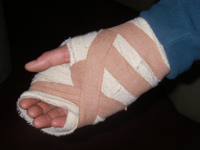 Granpa gets surgeory on hand