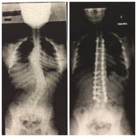 Scoliosis