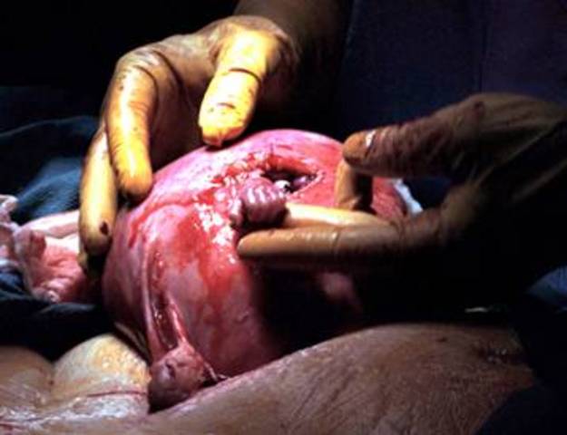 The 2nd Trimeste - 21 Week Medical Miracle