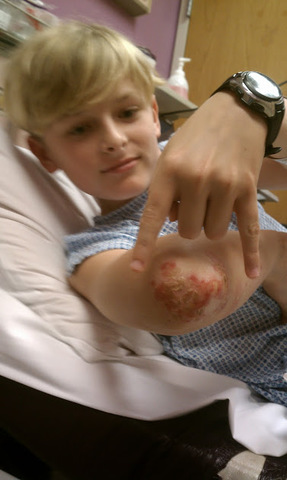 Tuve un Infección Grande