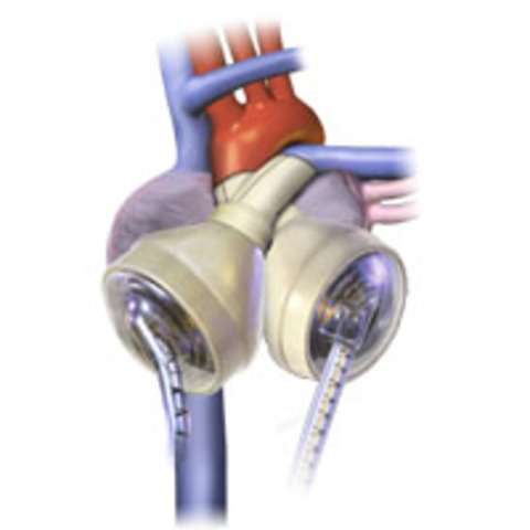 The Invention of an Artificial Heart
