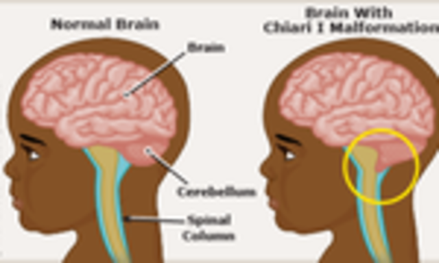 Decompression surgery