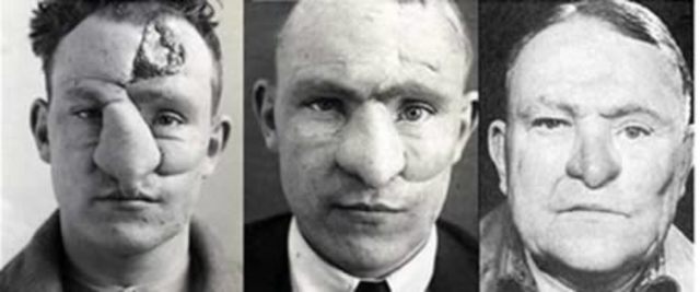 The reconstruction of the nose