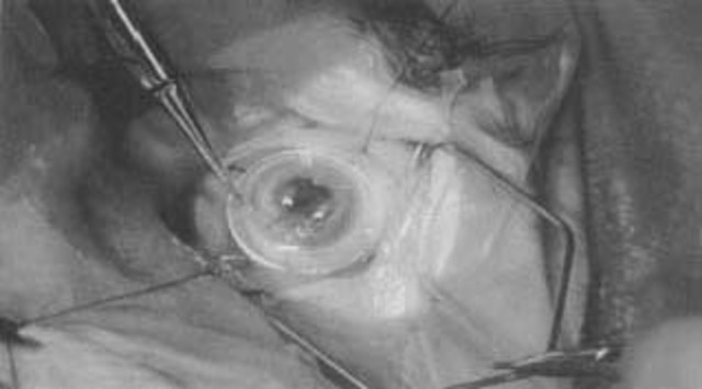 cornea transplant