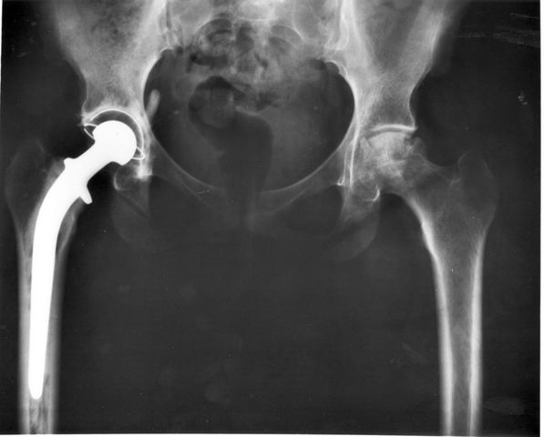 Metal hip replacement