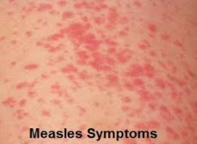 Measles first identified
