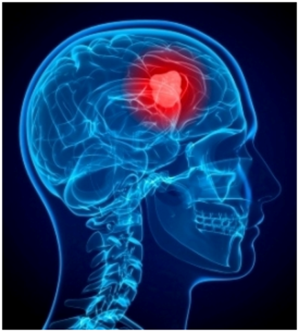 Brain cancer