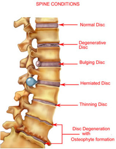 my mom fractures her disc