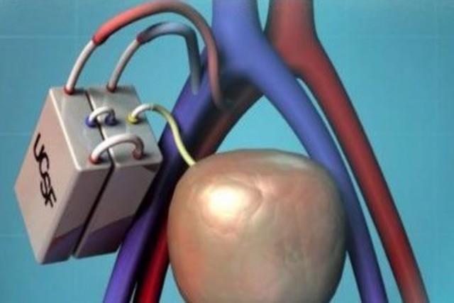 Se utiliza por primera vez un riñón artificial.