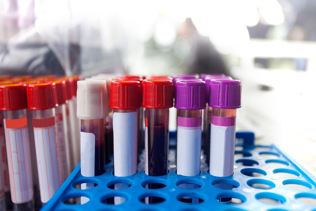 Scientists began developing blood-screening tests for infectious diseases