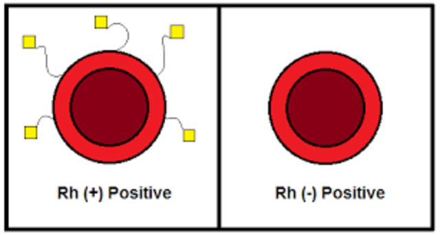 Landsteiner discovered Rh Protein