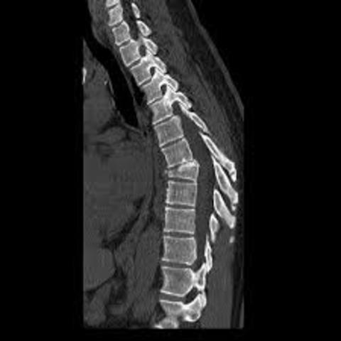 My mom broke her back