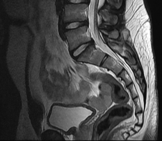 Imagen por resonancia magnética