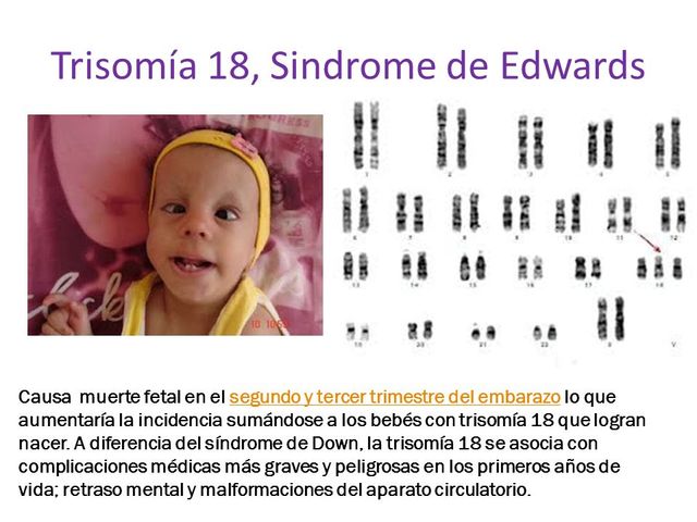 Trisomía 18
