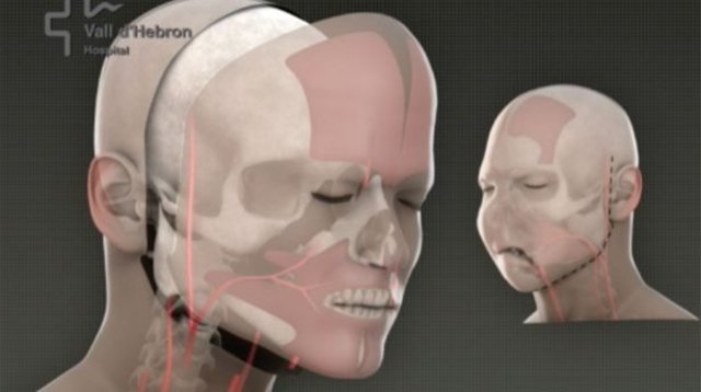 transplante total de cara