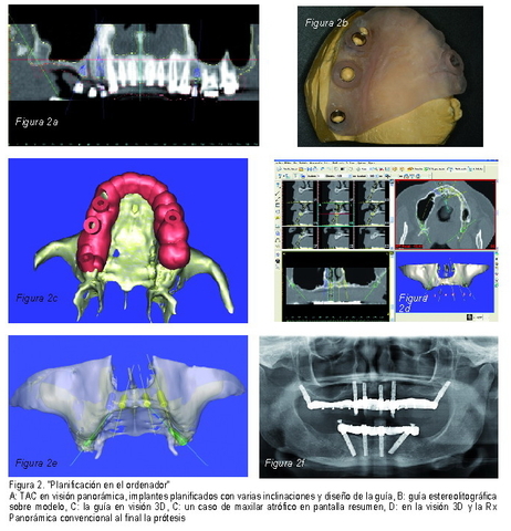 Cirugía e Implantología guiadas y asistidas por ordenador