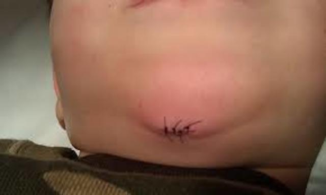 Stitches