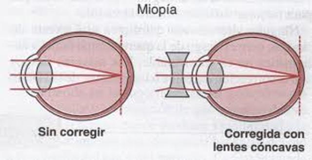 lentes concavos