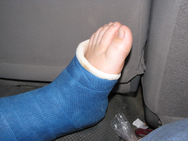 I broke my foot