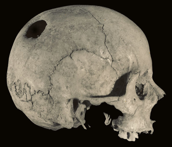 Trepanaciones