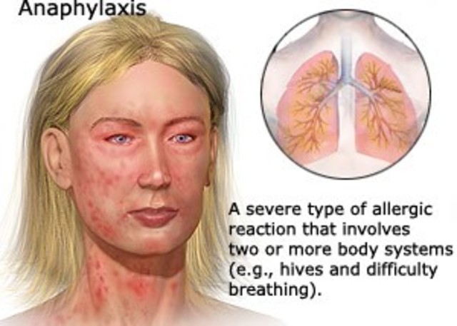 Smith: Anafilaxis