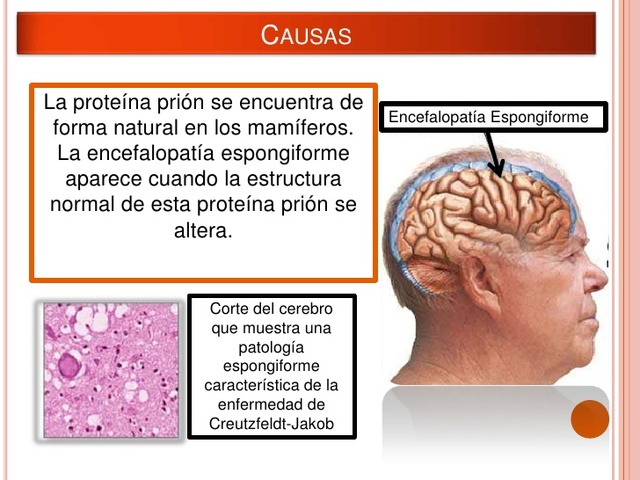 Enfermedad de Creutzfeldt-Jakob
