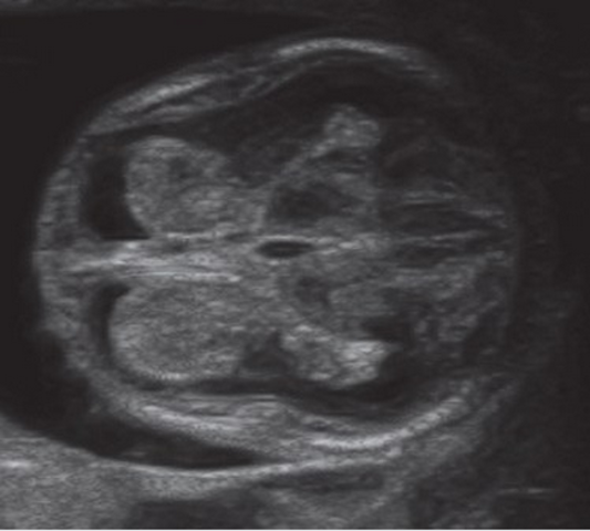 Desarrollo de hemisferios cerebrales