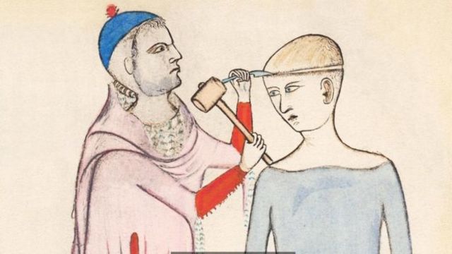Trepanaciones en el cráneo