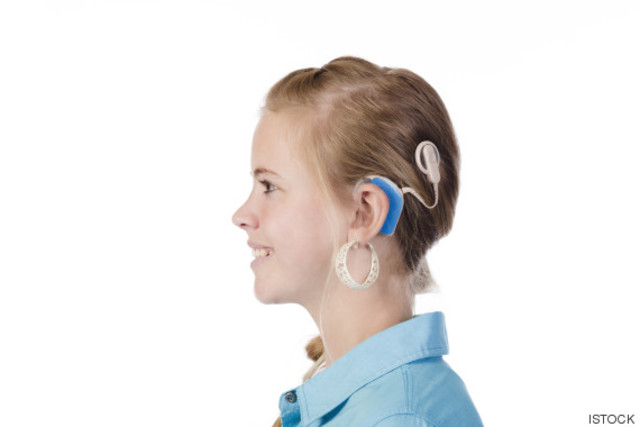 PRIMER IMPLANTE COCLEAR CANARIAS