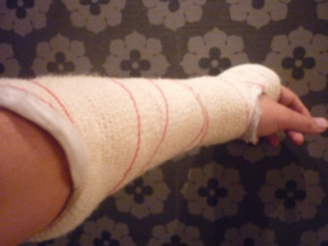 fractura del brazo izquierdo