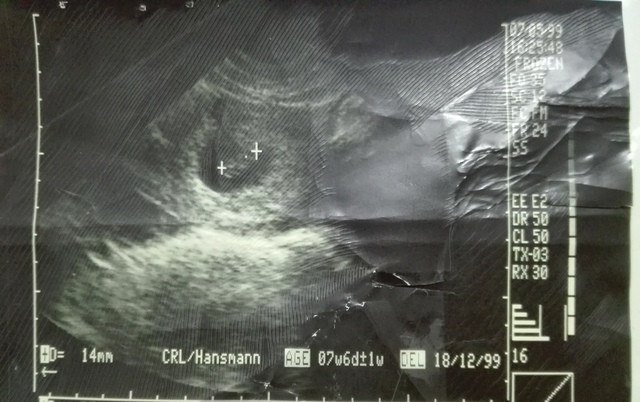 Mi primer ecografia