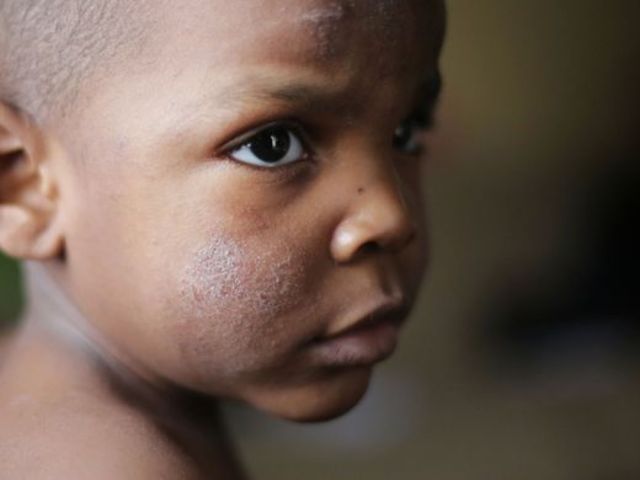 Doctors urge to stop using Flint River water